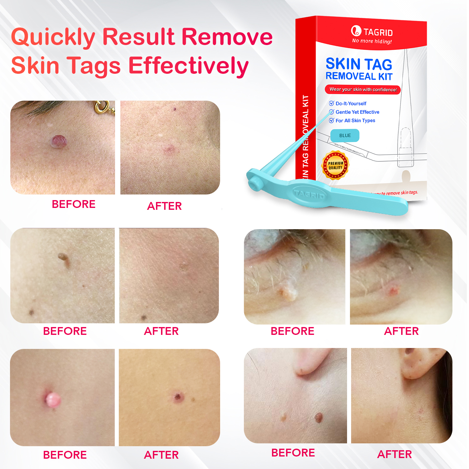 Different Types of Treatments for Skin Tag Removal - IPLOverview